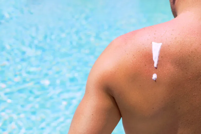 Danger of sunburn in direct bright sunshine